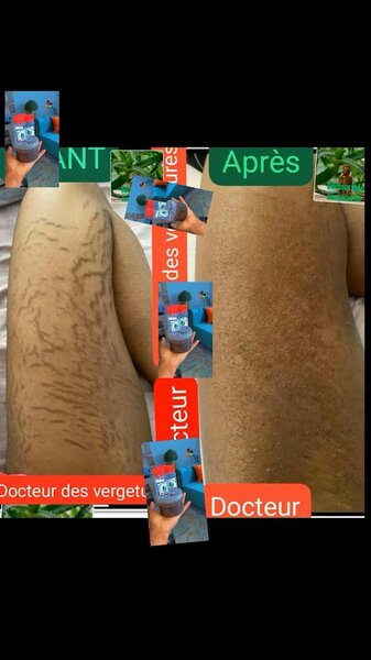 Docteur des vergetures