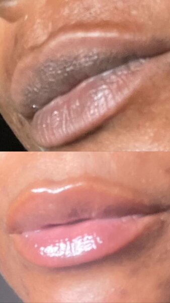 Lip Brightening Kit for Dark Lips