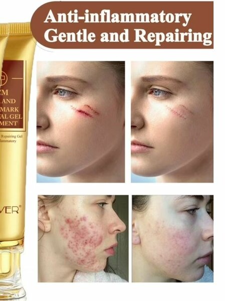 Acné brûlures, vergetures