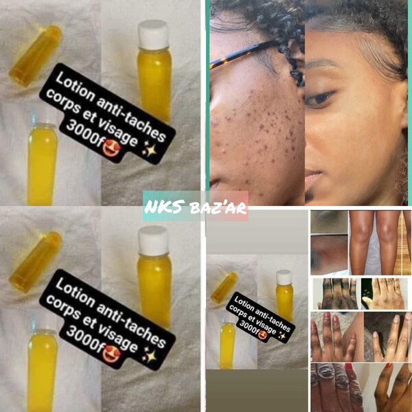 Finit les taches et le visage gras à partir de 10 jours