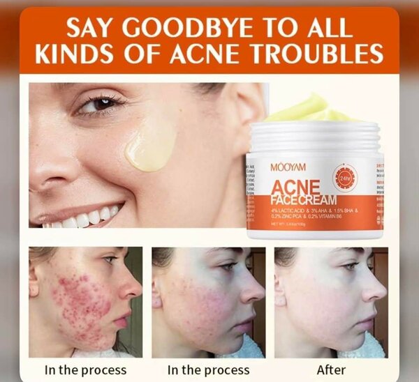 MOOYAM ACNE face cream
