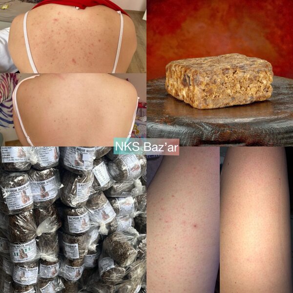 Traitez les boutons, gales, taches et illuminez votre peau