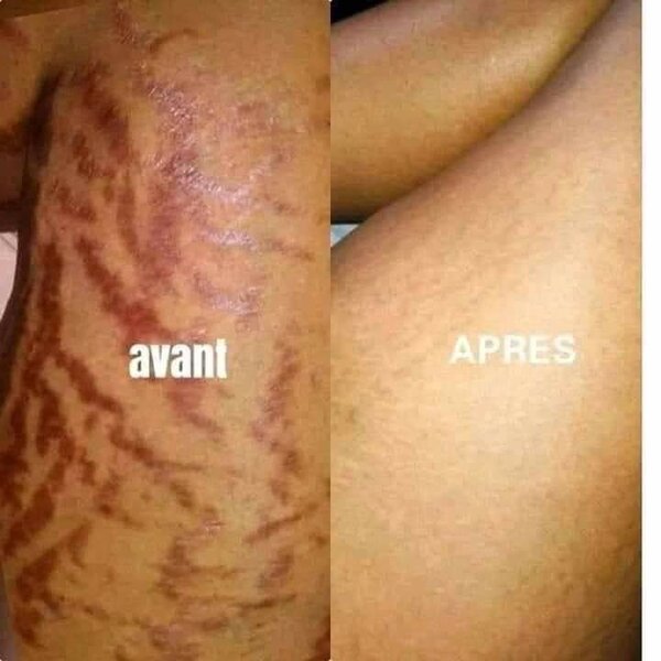 Savon peeling vergetures