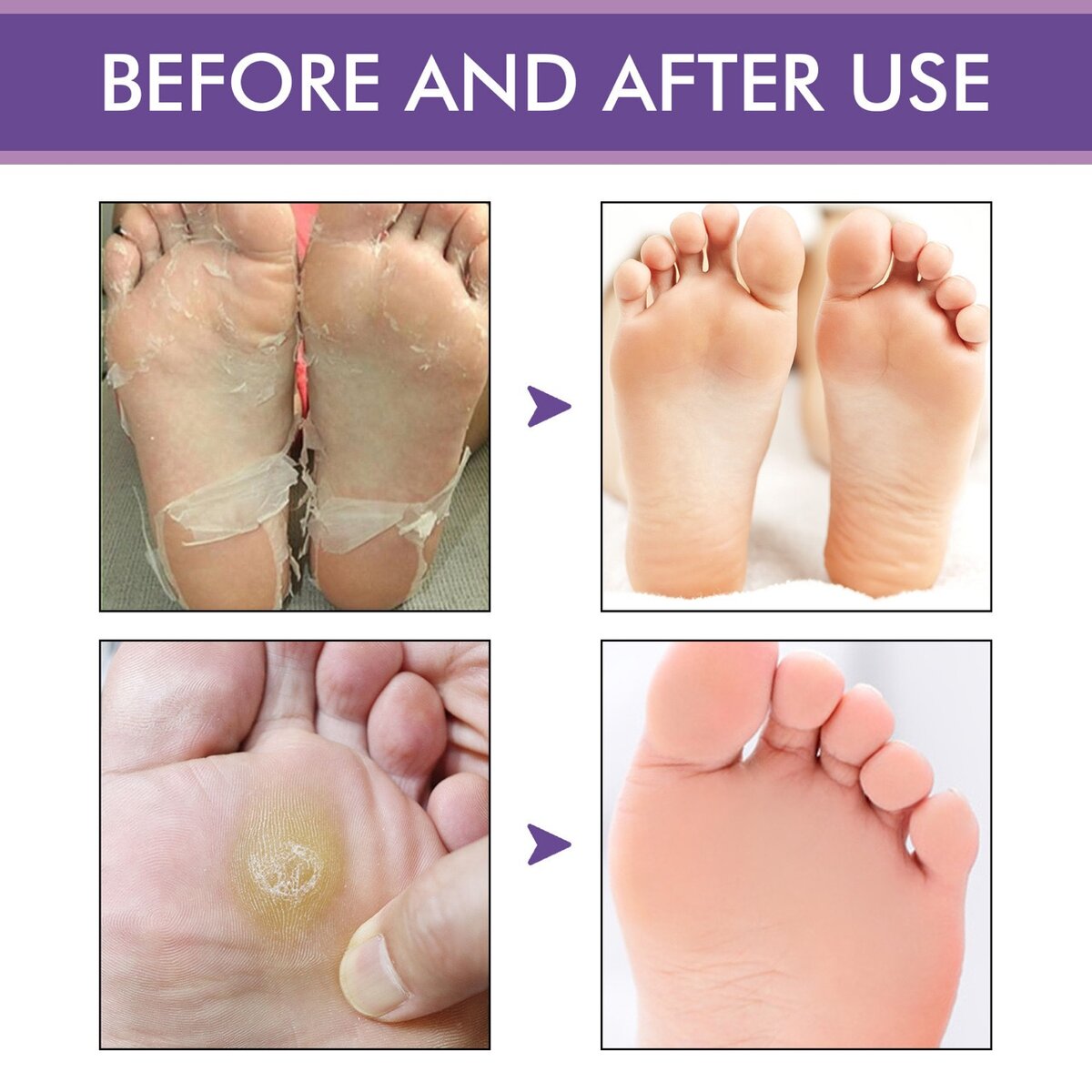 Foot peeling mask