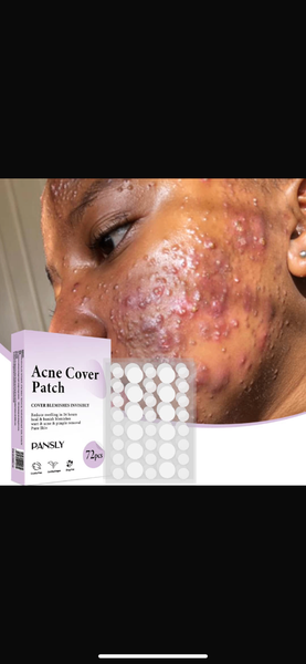 Acne patches