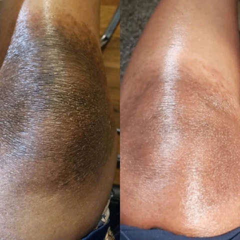 Lotion peeling quinto tâches noires