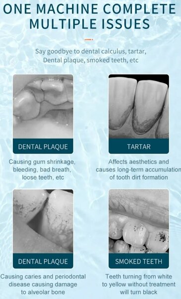 Détartrage Dentaire Électrique