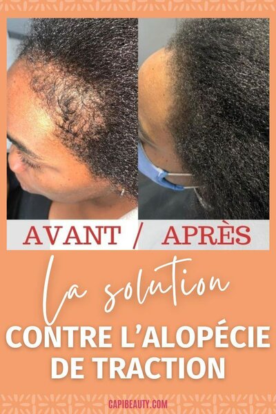 Pousse rapide des cheveux