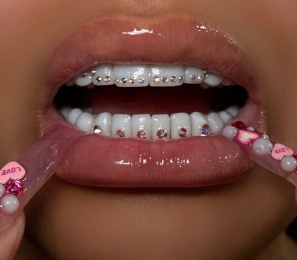 Tooth gems