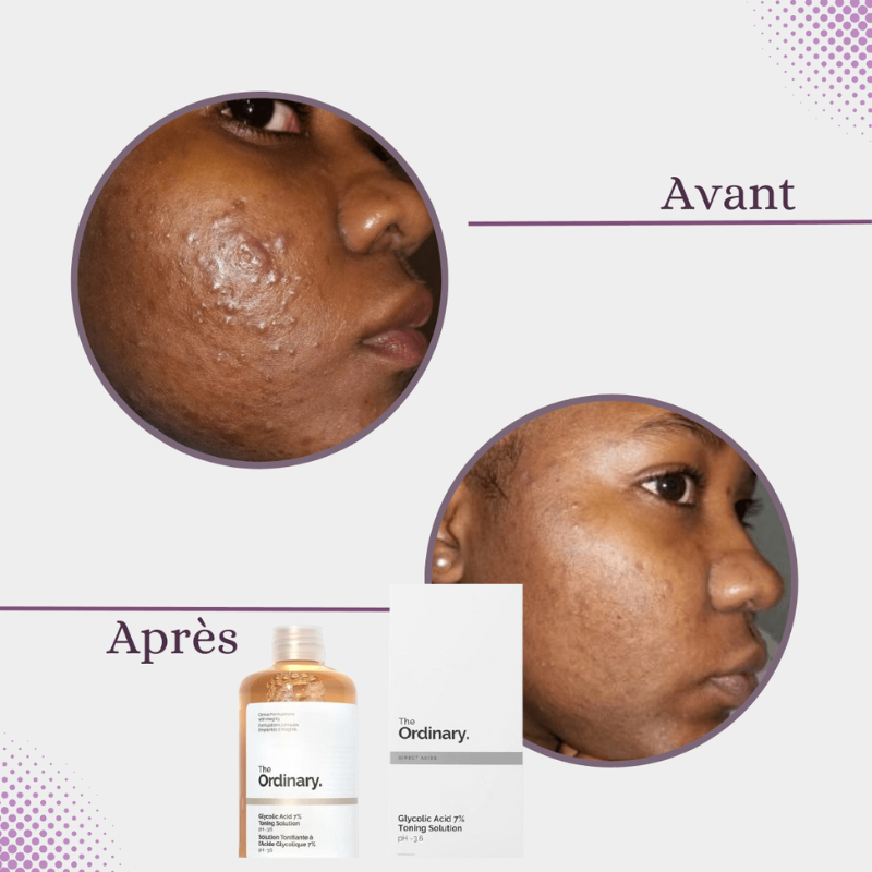 Tonique Exfoliant The Ordinary