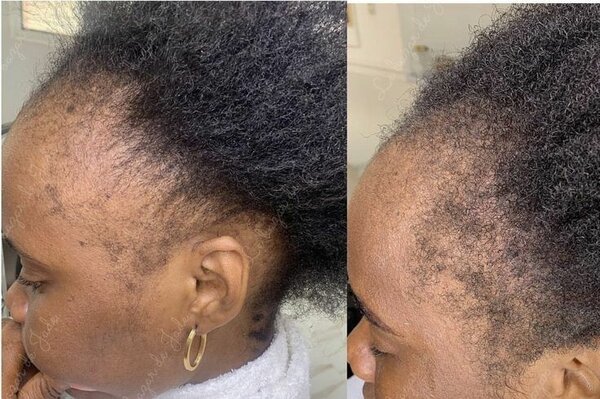 Pousse rapide des cheveux